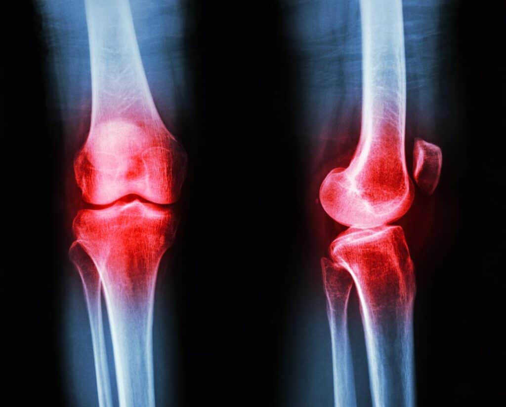 Osteoarthritic Knees